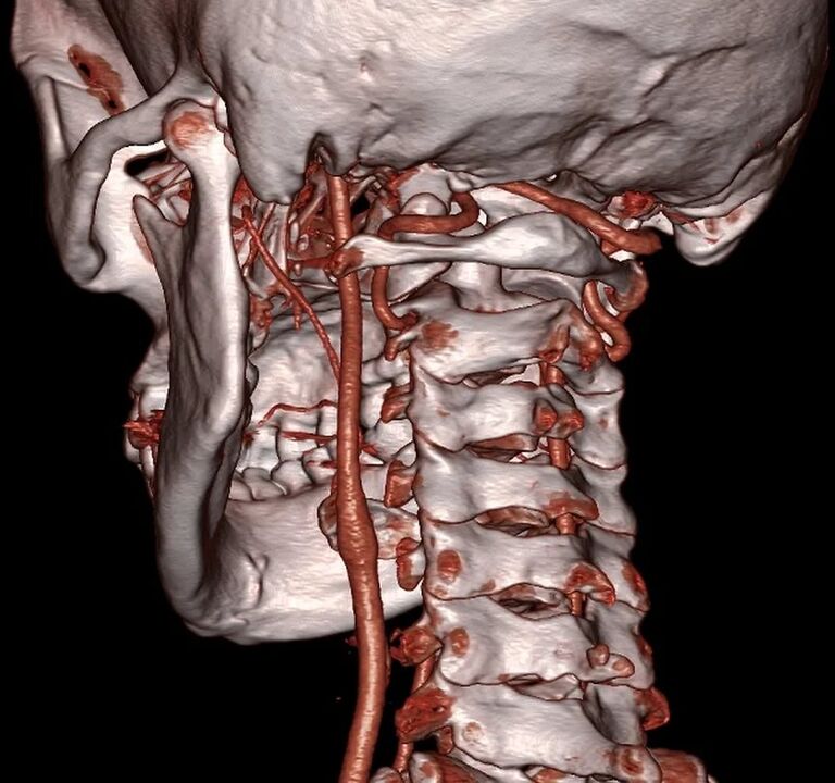 servikal osteokondrozlu arter sıkışması