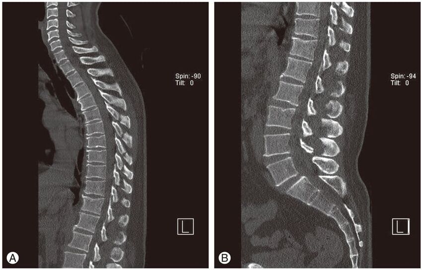 Torasik osteokondrozda MR görüntülerinde intervertebral disklerin deformasyonu